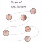 El parche de terapia de cicatrices de gel de silicona orgánica se lava y se reutiliza - Imagen 3