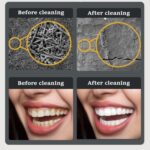 Escalador Dental eléctrico ultrasónico, limpiador de placa de dientes, eliminación de piedra Dental con luz LED, Package B - Imagen 7